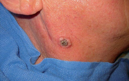 AZUR-blog-mole-check-squamous-cell-carcinoma1