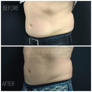 Male Stomach After Coolsculpting