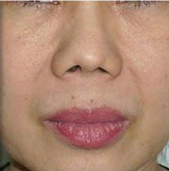 Laser facelift after 1