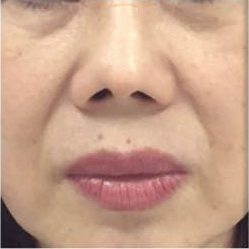 Laser facelift before 1