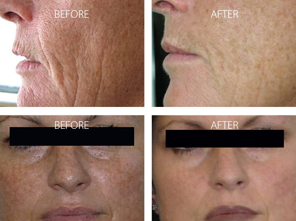 Omnilux Light skin rejuvenation cottesloe - omnilux cottesloe (1) Omnilux Light skin rejuvenation cottesloe - omnilux cottesloe (1)