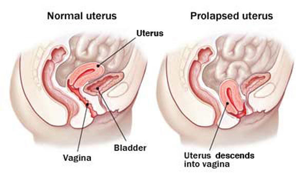 Vaginal Prolapse - perth - azure medical Vaginal Prolapse - perth - azure medical