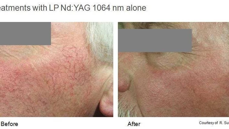 Rosacea treatment perth - rosacea treatment cottesloe (2) Rosacea treatment perth - rosacea treatment cottesloe (2)