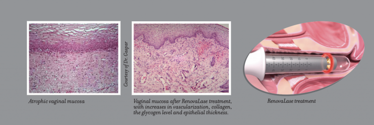 vagina dryness treatment - menopause vagina treatment - renovalase.png vagina dryness treatment - menopause vagina treatment - renovalase.png