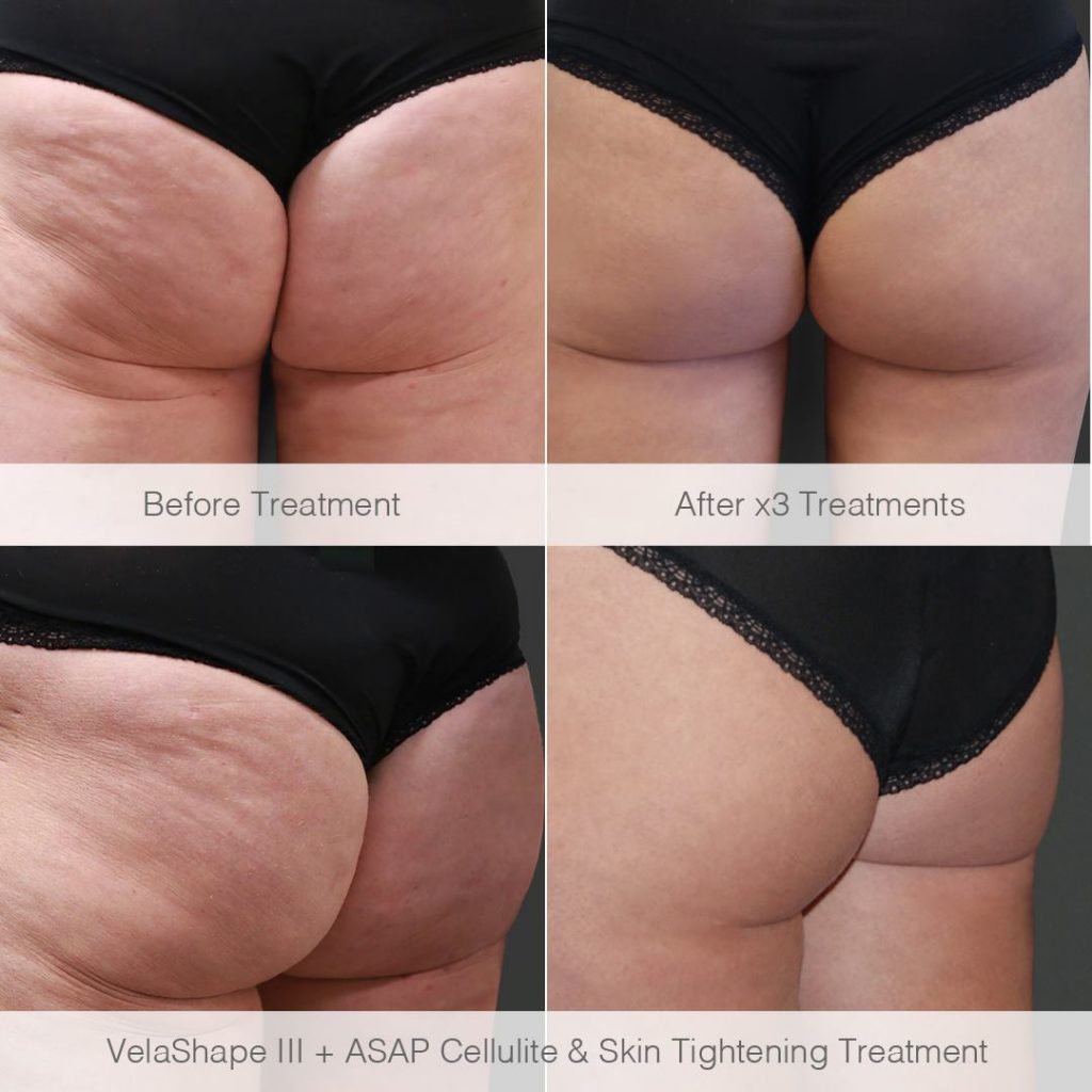 Velashape - cellulite treatment perth - cellulite treatment cottesloe