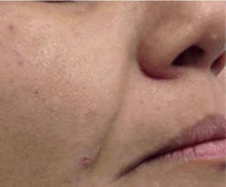 laser facelift after 2