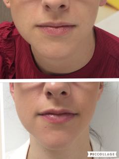 laser lip plumping perth - laser lip plumping cottesloe laser lip plumping perth - laser lip plumping cottesloe