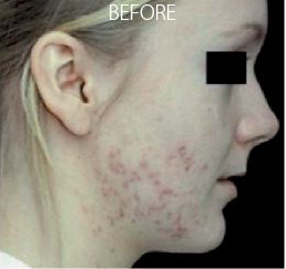 omnilux acne before 1