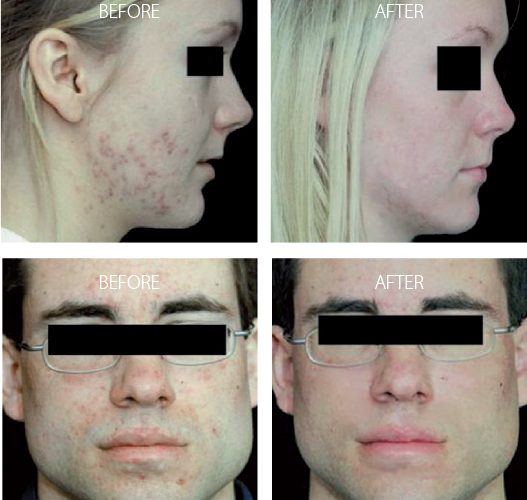 omnilux light treatment - acne treatment perth omnilux light treatment - acne treatment perth