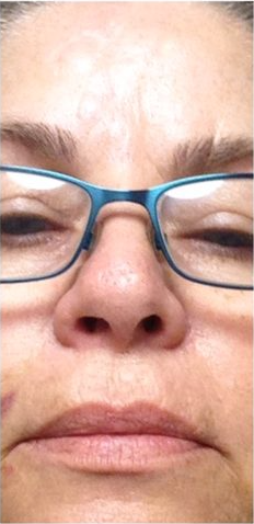 wrinkle relaxers after