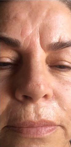 wrinkle relaxers before