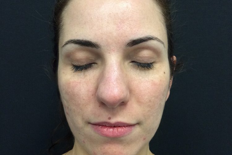 1. pre laser front - acne scarring treatment perth