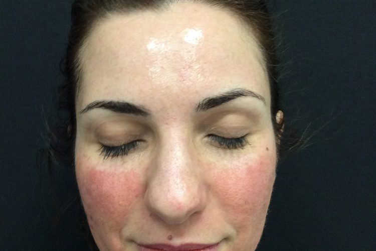 2. Immediately post laser - acne scarring treatment perth