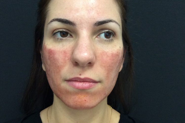 3) Day 1 Post Laser - acne scarring treatment perth