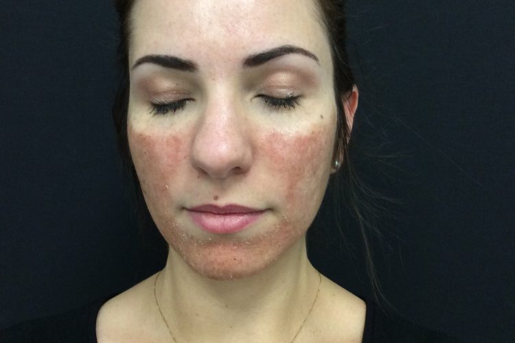 4. Day 3 Post Laser Front - acne scarring treatment perth