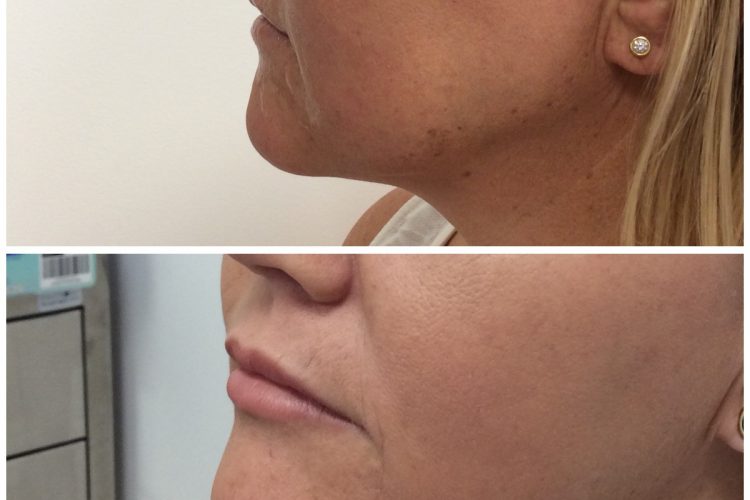 cheek fillers perth - dermal fillers for face..jpg cheek fillers perth - dermal fillers for face..jpg
