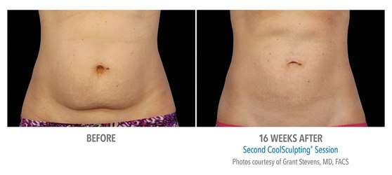 coolsculpting perth - coolsculpting cottesloe - fat freezing perth (2) coolsculpting results on stomach