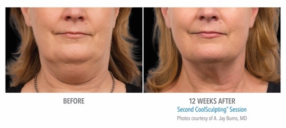 coolsculpting perth - coolsculpting cottesloe - fat freezing perth (3) coolsculpting results on neck fat
