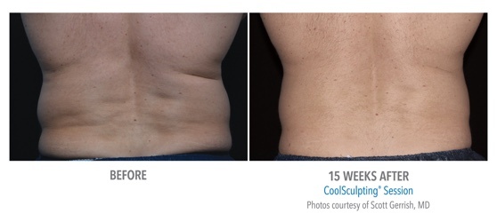 coolsculpting perth - coolsculpting cottesloe - fat freezing perth (6) coolsculpting result on back