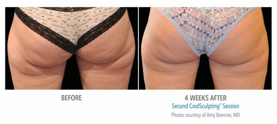 coolsculpting perth - coolsculpting cottesloe - fat freezing perth (9) coolsculpting result on thighs