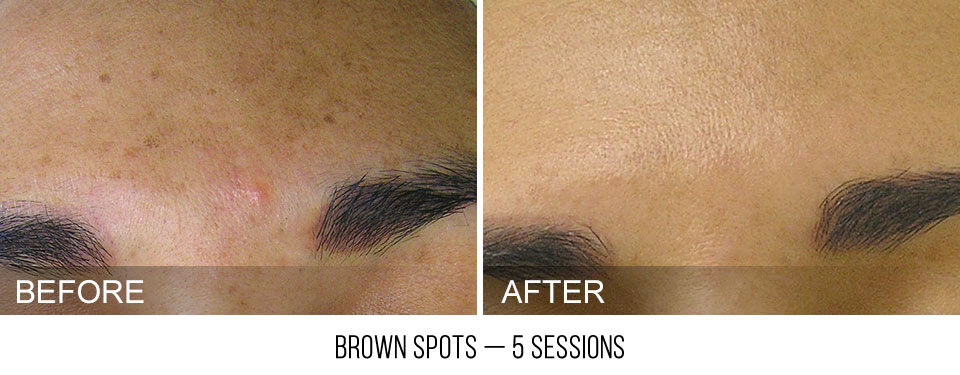hydrafacial-before-after-BrownSpots-caption hydrafacial-before-after-BrownSpots-caption