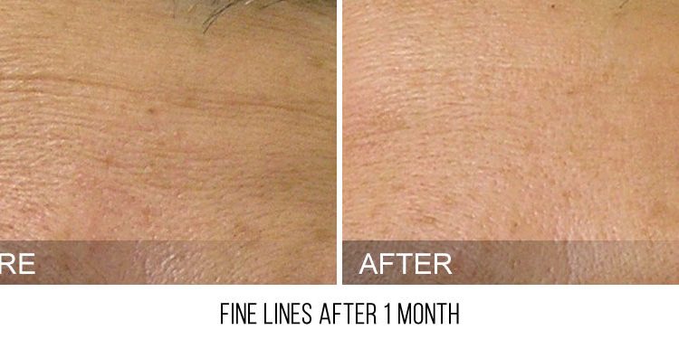 hydrafacial cottesloe - hydrafacial perth - facials in cottesloe (2) hydrafacial cottesloe - hydrafacial perth - facials in cottesloe (2)