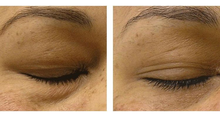 hydrafacial cottesloe - hydrafacial perth - facials in cottesloe (3) hydrafacial cottesloe - hydrafacial perth - facials in cottesloe (3)