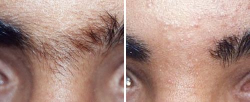 ipl hair removal near me