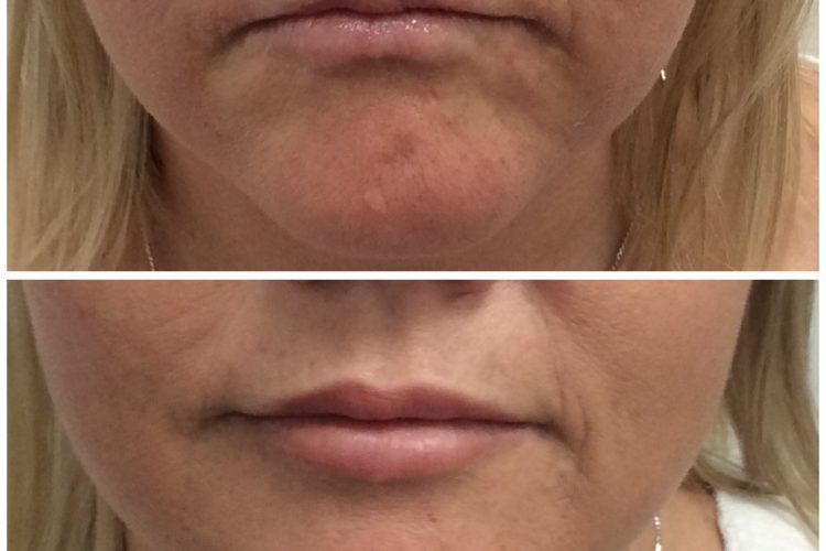 lip fillers perth - dermal fillers for face. lip fillers perth - dermal fillers for face.