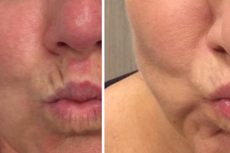 lip line fillers perth - dermal fillers for face..jpg lip line fillers perth - dermal fillers for face..jpg