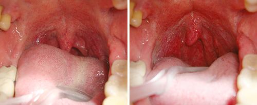 nightlase snoring treatment perth - how to stop snoring - snoring treatments (2) nightlase snoring treatment perth - how to stop snoring - snoring treatments (2)