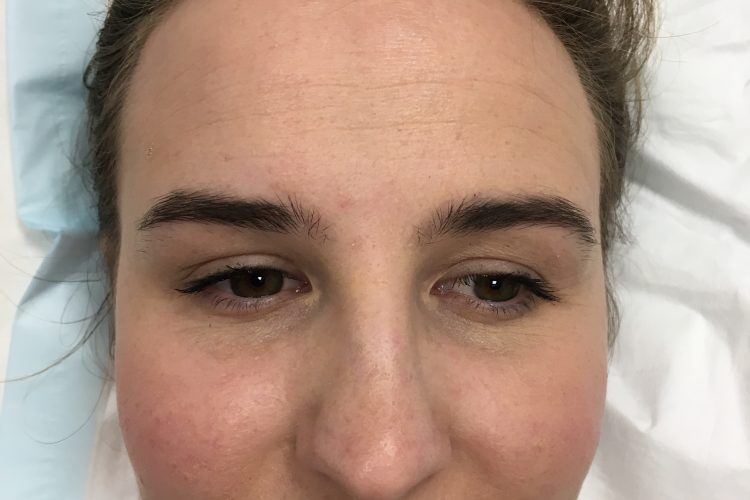 safe wrinkle relaxers perth - wrinkle relaxer perth (1) safe wrinkle relaxers perth - wrinkle relaxer perth (1)