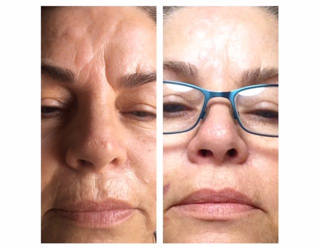 safe wrinkle relaxers perth - wrinkle relaxer perth (3) safe wrinkle relaxers perth - wrinkle relaxer perth (3)
