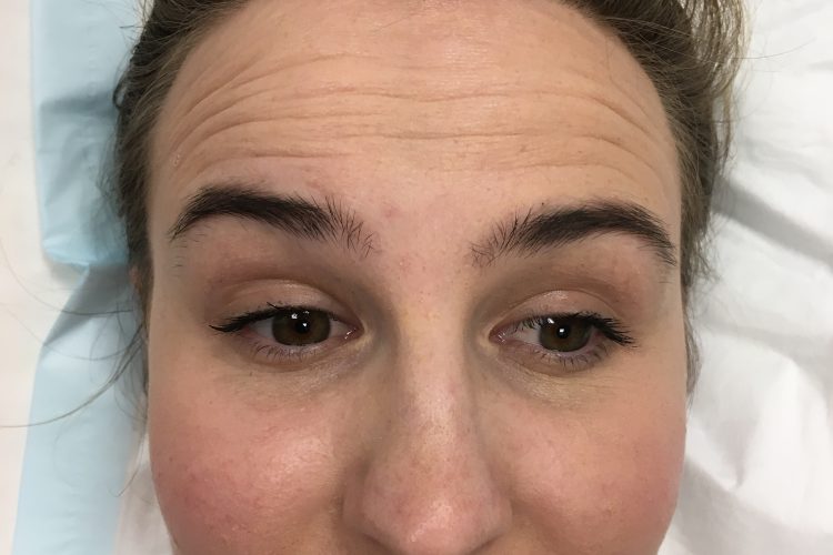 safe wrinkle relaxers perth - wrinkle relaxer perth (5) safe wrinkle relaxers perth - wrinkle relaxer perth (5)