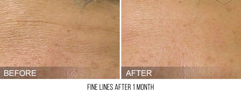 hydrafacial-before-after-FineLines-caption