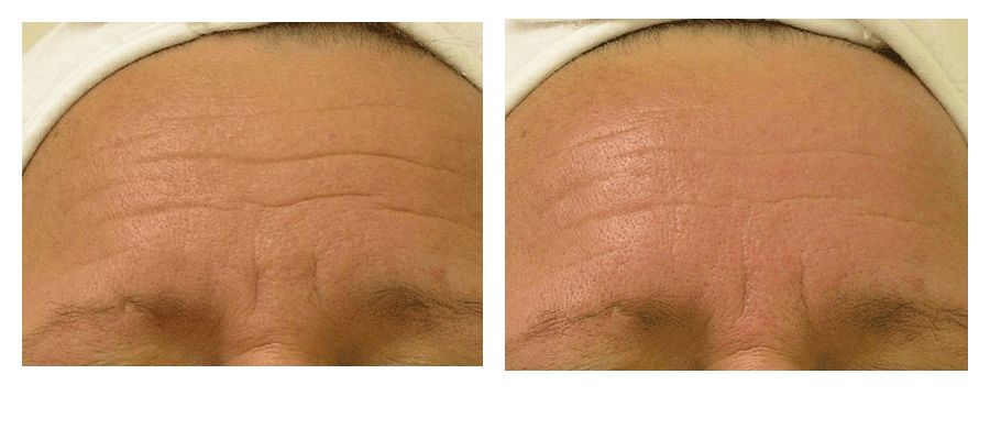 hydrafacial-before-after-Wrinkles-Large1