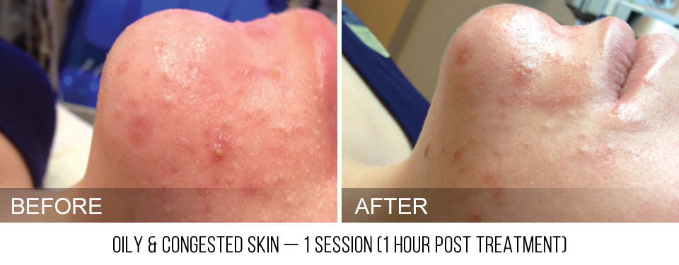 hydrafacial-before-after-oily-congested-caption hydrafacial-before-after-oily-congested-caption