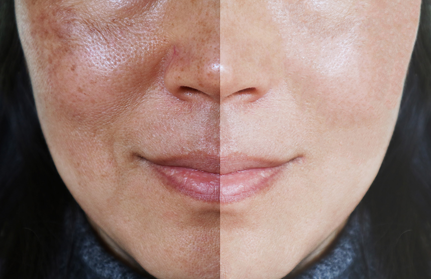 Melasma treatment pigmentation dermamelan perth cottesloe