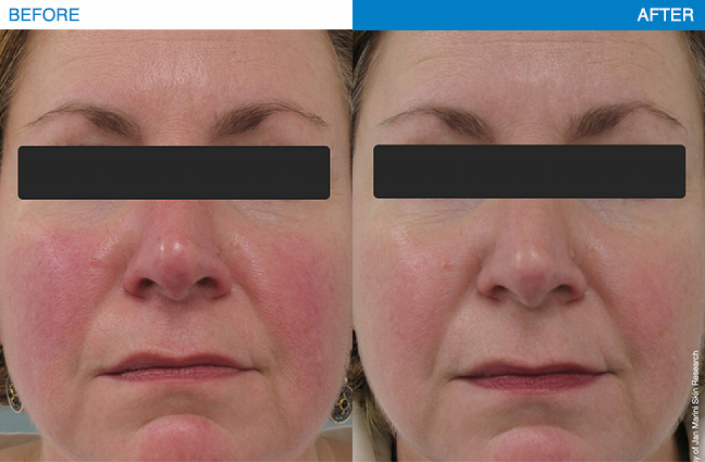 Rosacea treatment results using Jan Marini products.