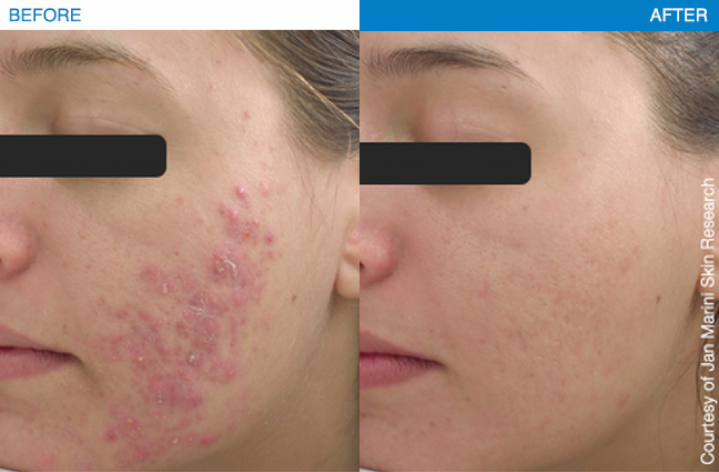 Acne Treatment results using Jan Marini products.