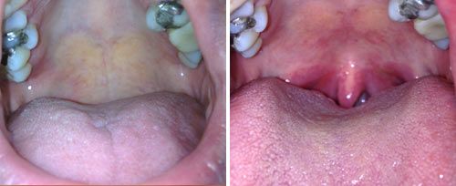 before and after treatment images of throat. the after image shows a much clearer throat passage.