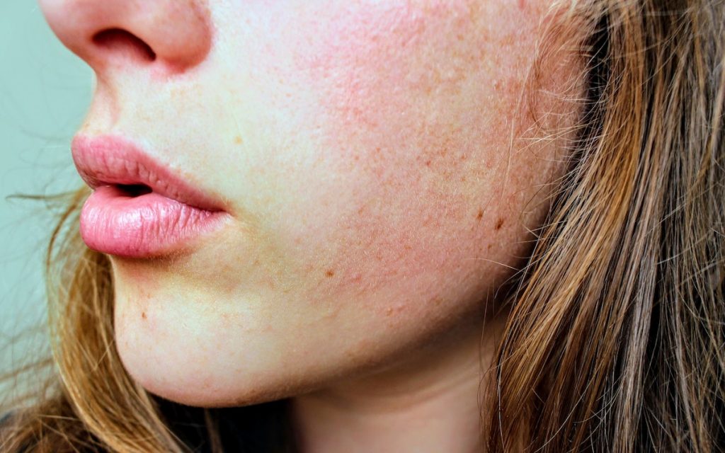 rosacea on a woman's cheek