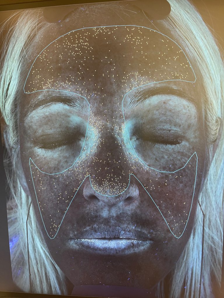 womans face is digitally mapped by the visia machine to show her skin spots.