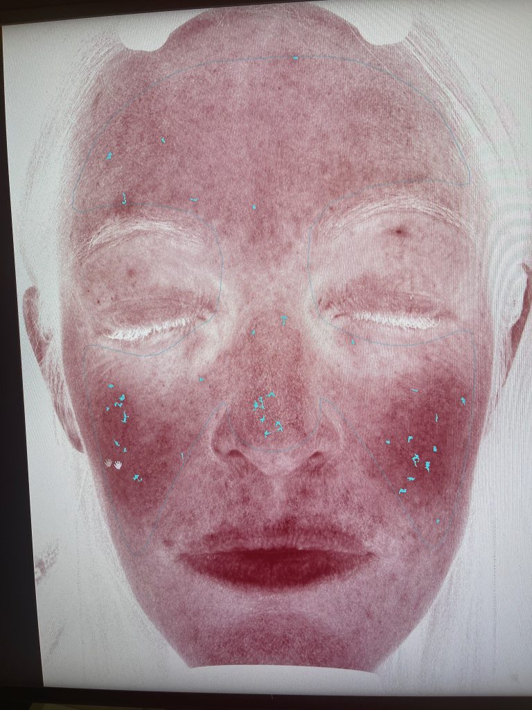 womans face is mapped with the visia machine showing her red spots
