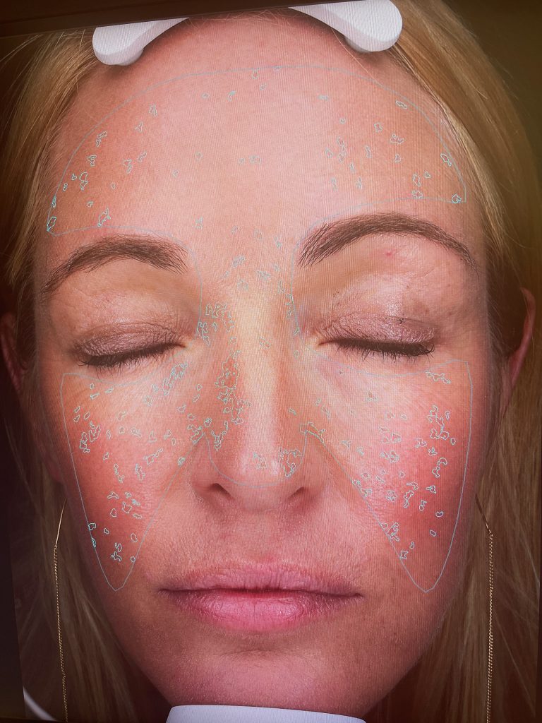 womans face is mapped with the visia machine showing her spots