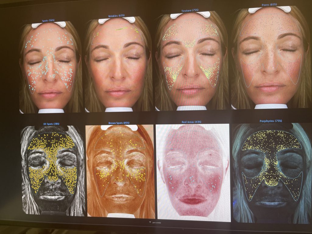 results from the visia skin imaging which maps out a woman's skin on her face.