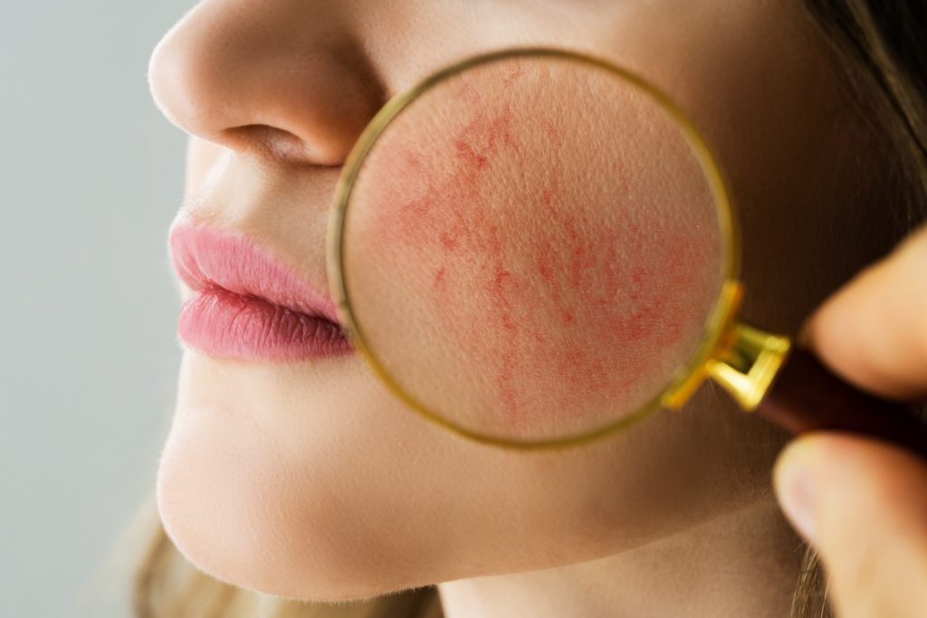 Rosacea Face Skin Problem And Aesthetic Treatment
