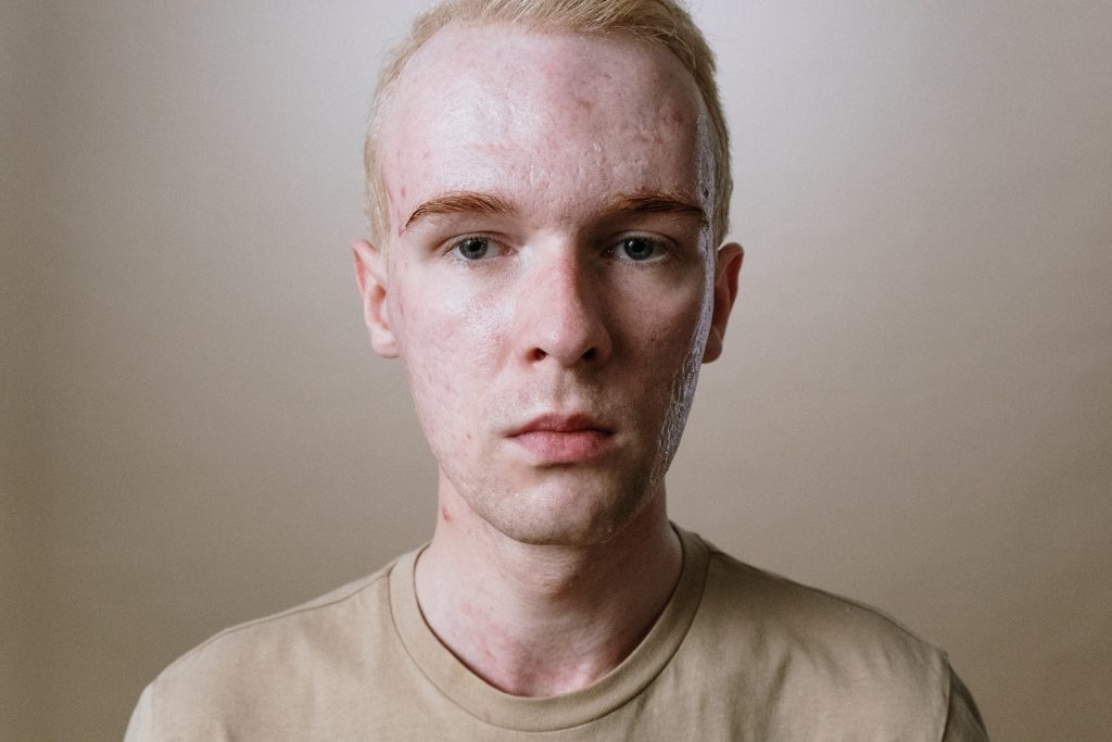 a young man looks at the camera sadly with acne pimples and scars on his face.