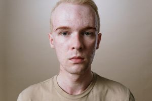 a young man looks at the camera sadly with acne pimples and scars on his face.