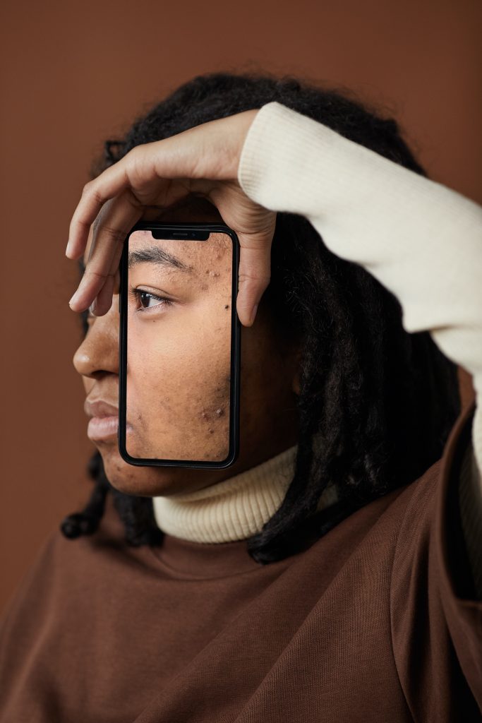 a teen camera holds up a phone camera to her face, to show her acne.